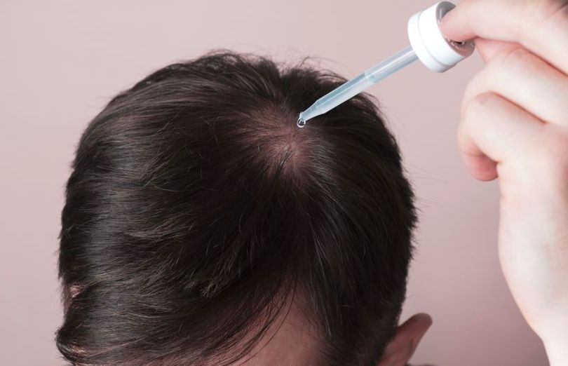 Applying a topical minoxidil and finasteride solution to the scalp with a dropper